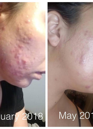 Organic Super Acne Fighter