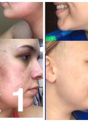 Organic Super Acne Fighter